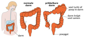 221229-nhg-afbeelding-Dikke darm-PDS