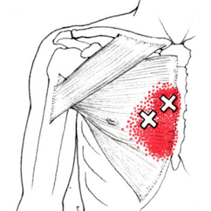 Dry-needling-borst-regio