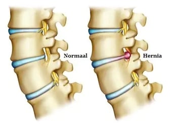 Hoe-ziet-een-hernia-er-uit