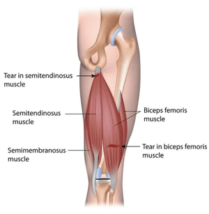 Hamstring