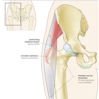 busitis