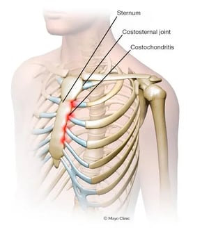 costochondritis