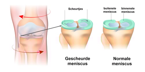gescheurde-meniscus1-1
