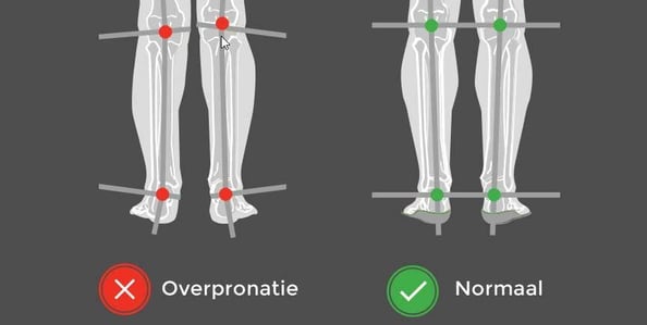 overpronatie-30005798