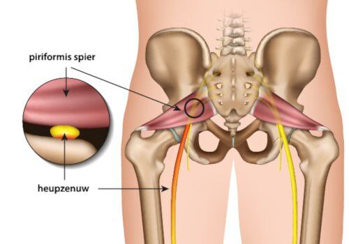 piriformis-syndroom-beknelling