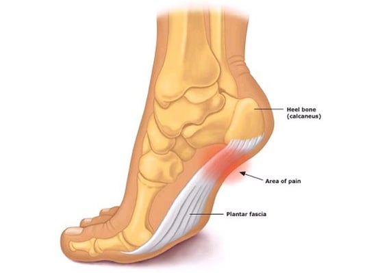 plantarfascia