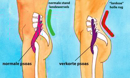 psoas-lordosis-tekening-1024x618
