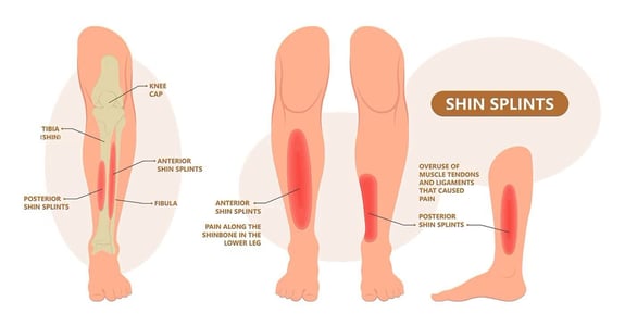 shin-splints-e1682795980271