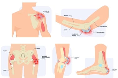 slijmbeursontsteking-informatie-brace